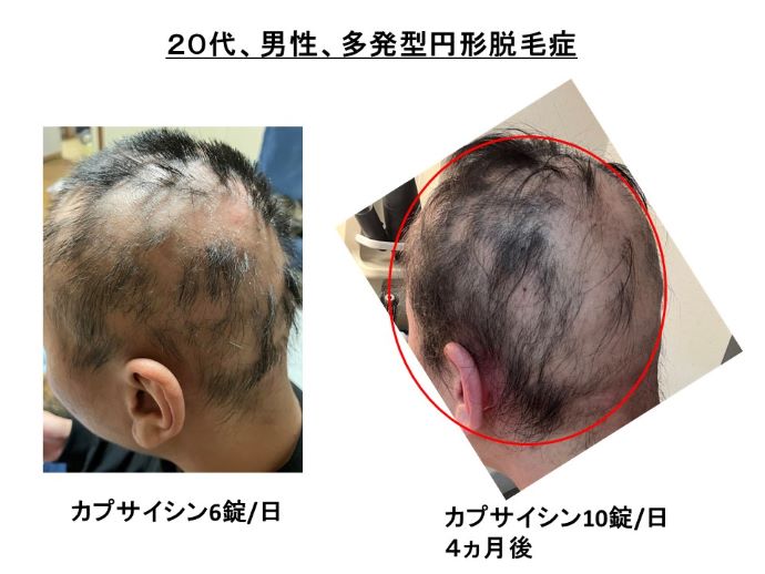 円形脱毛症　病院